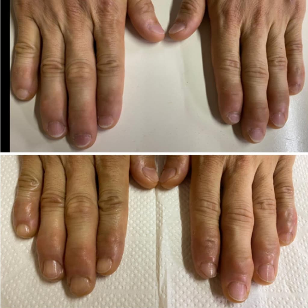 アスリートネイル変化例1