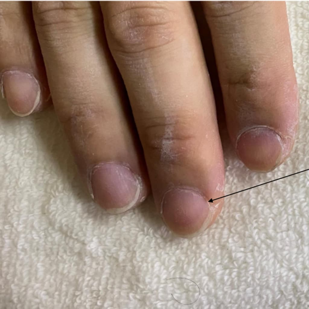 アスリートネイル変化例4